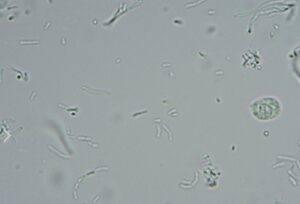 細菌感染が認めらた尿　細長い物体が桿菌、丸い細胞が白血球